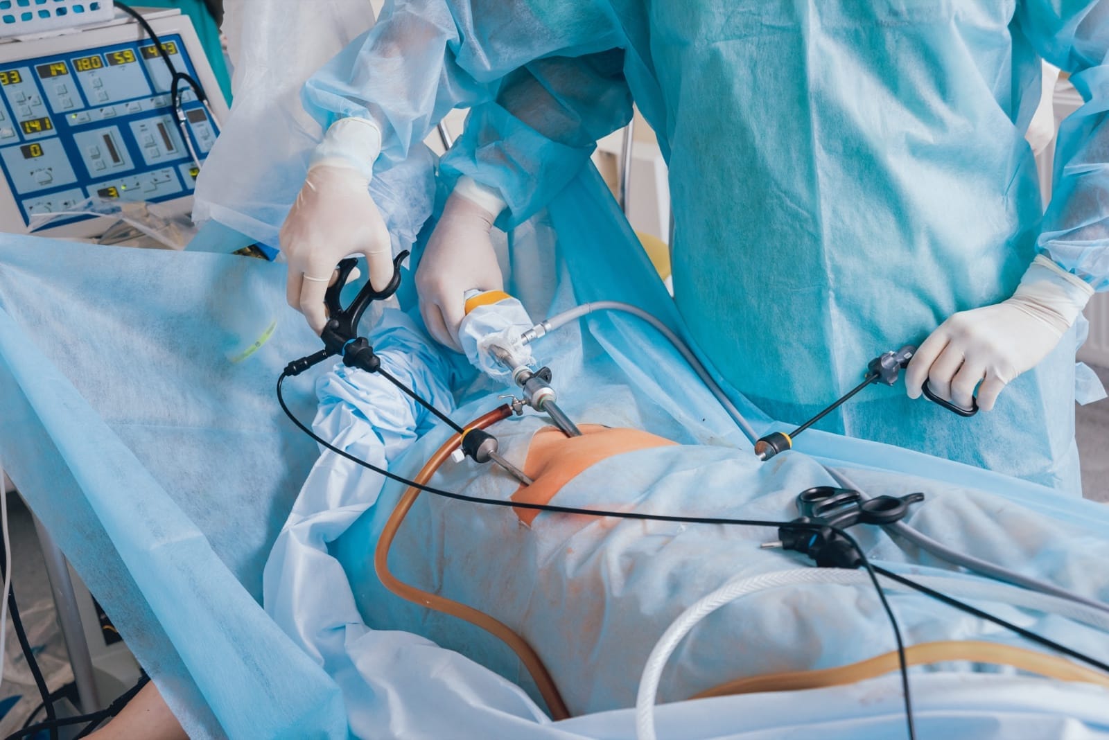 A surgical team performing a laparoscopic procedure