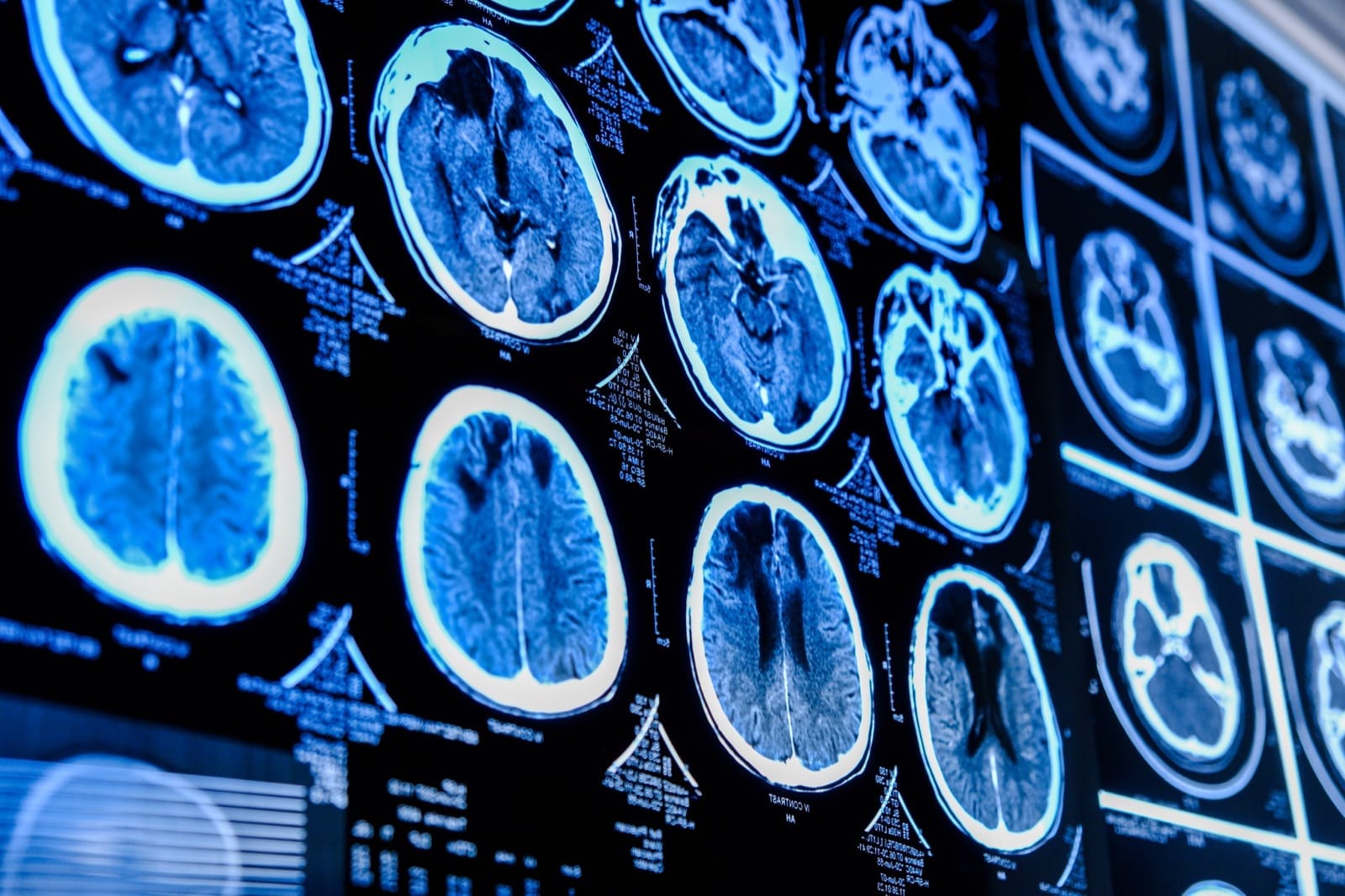Neurological scan images displayed for clinical review