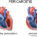 First Cardiology Consultant - Pericarditis