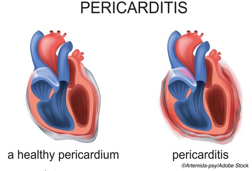 First Cardiology Consultant - Pericarditis